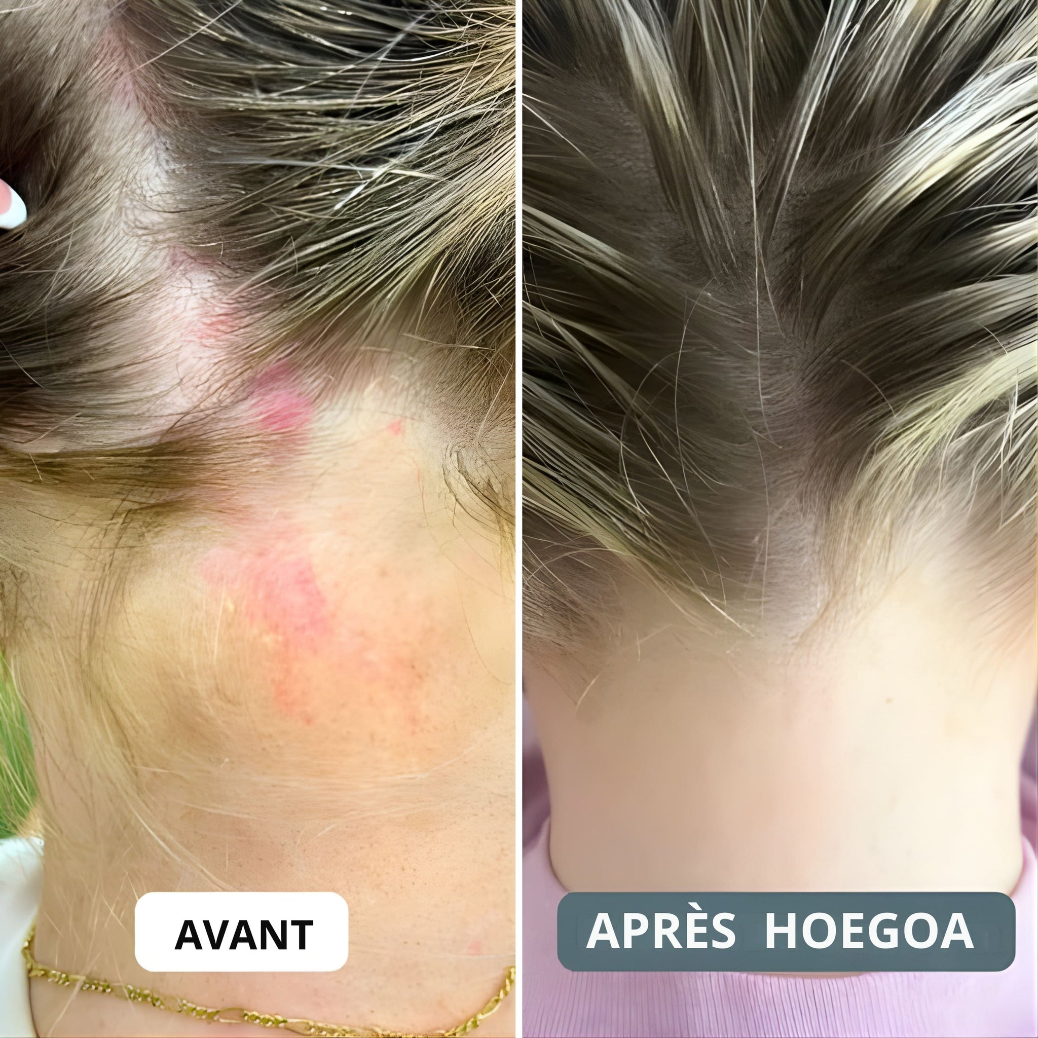 HOEGOA Crème ⎜ Apaise le cuir chevelu et la peau