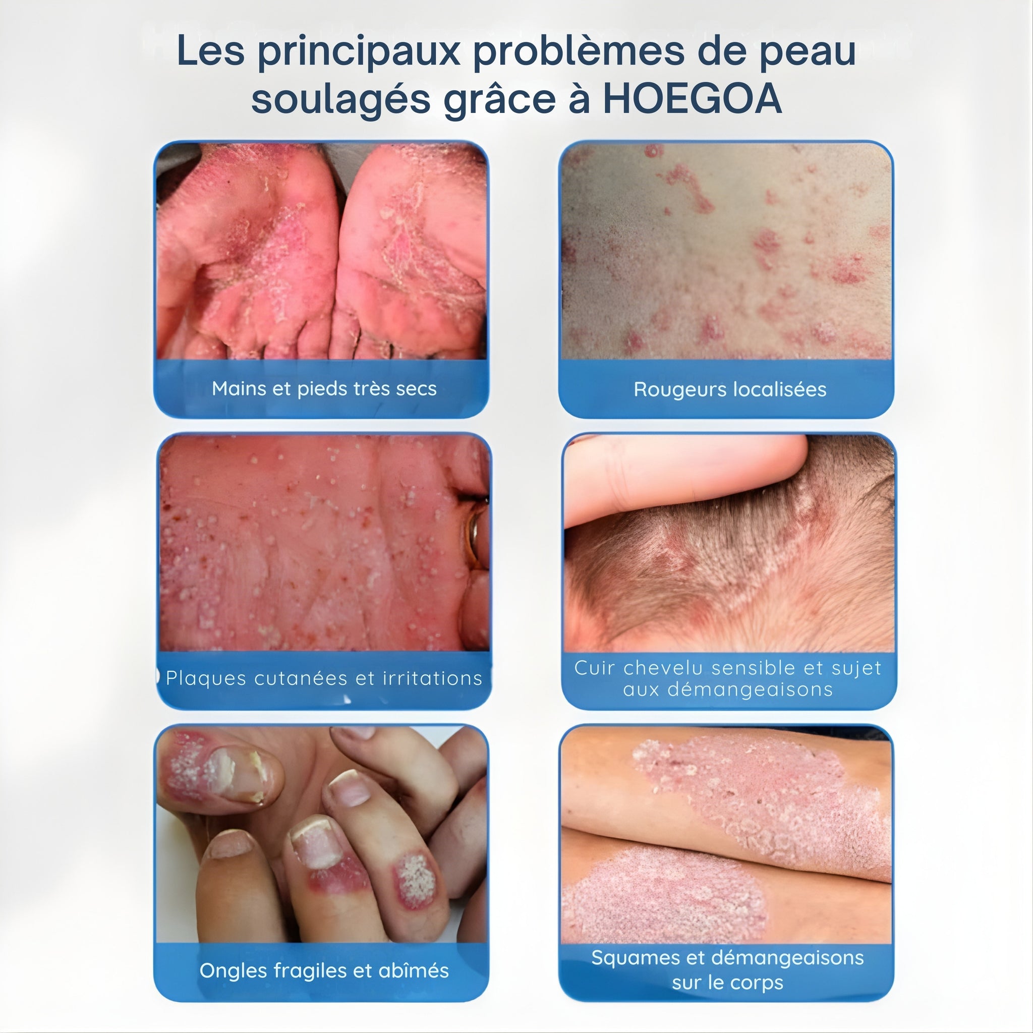 HOEGOA Crème ⎜ Apaise le cuir chevelu et la peau