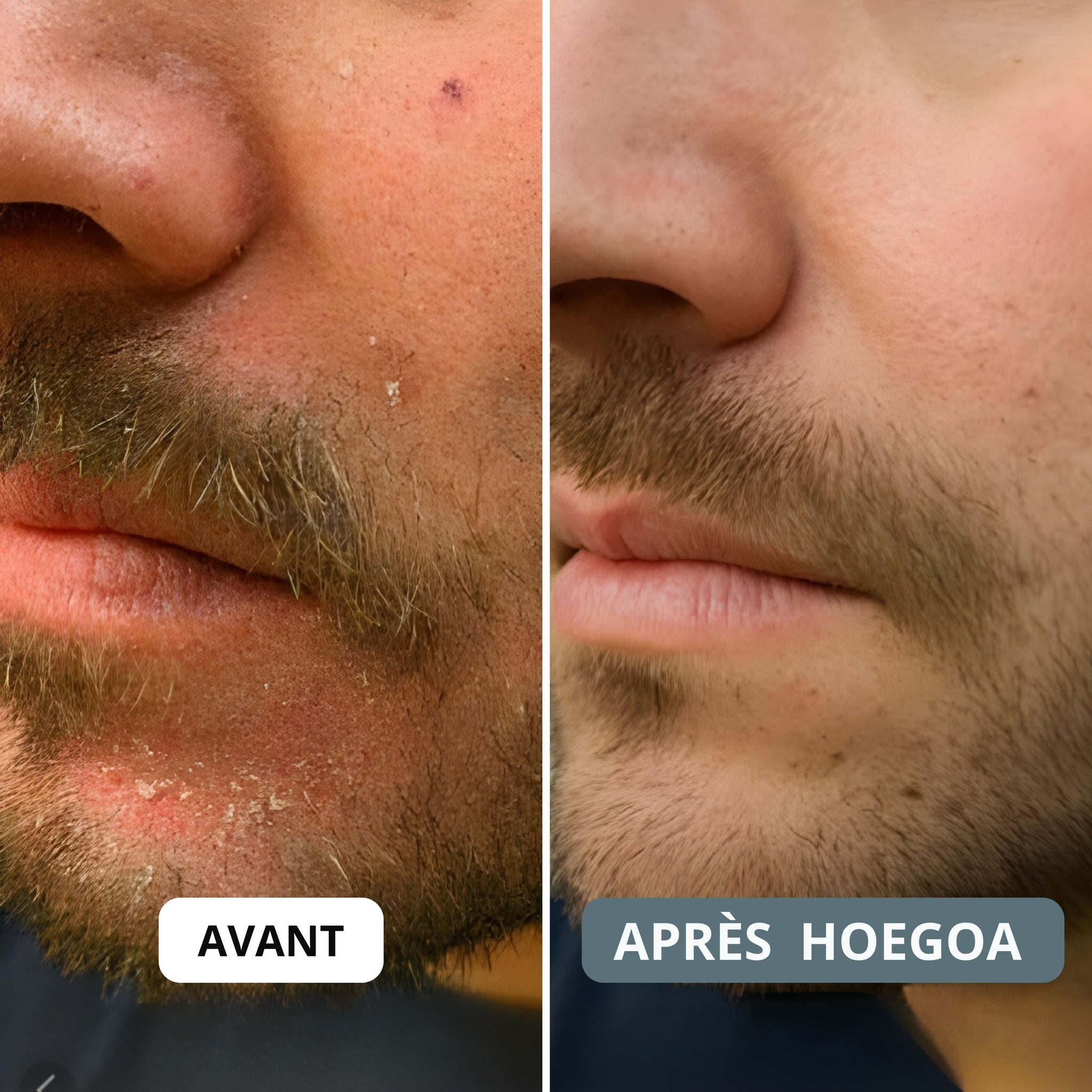 HOEGOA Crème ⎜ Apaise le cuir chevelu et la peau