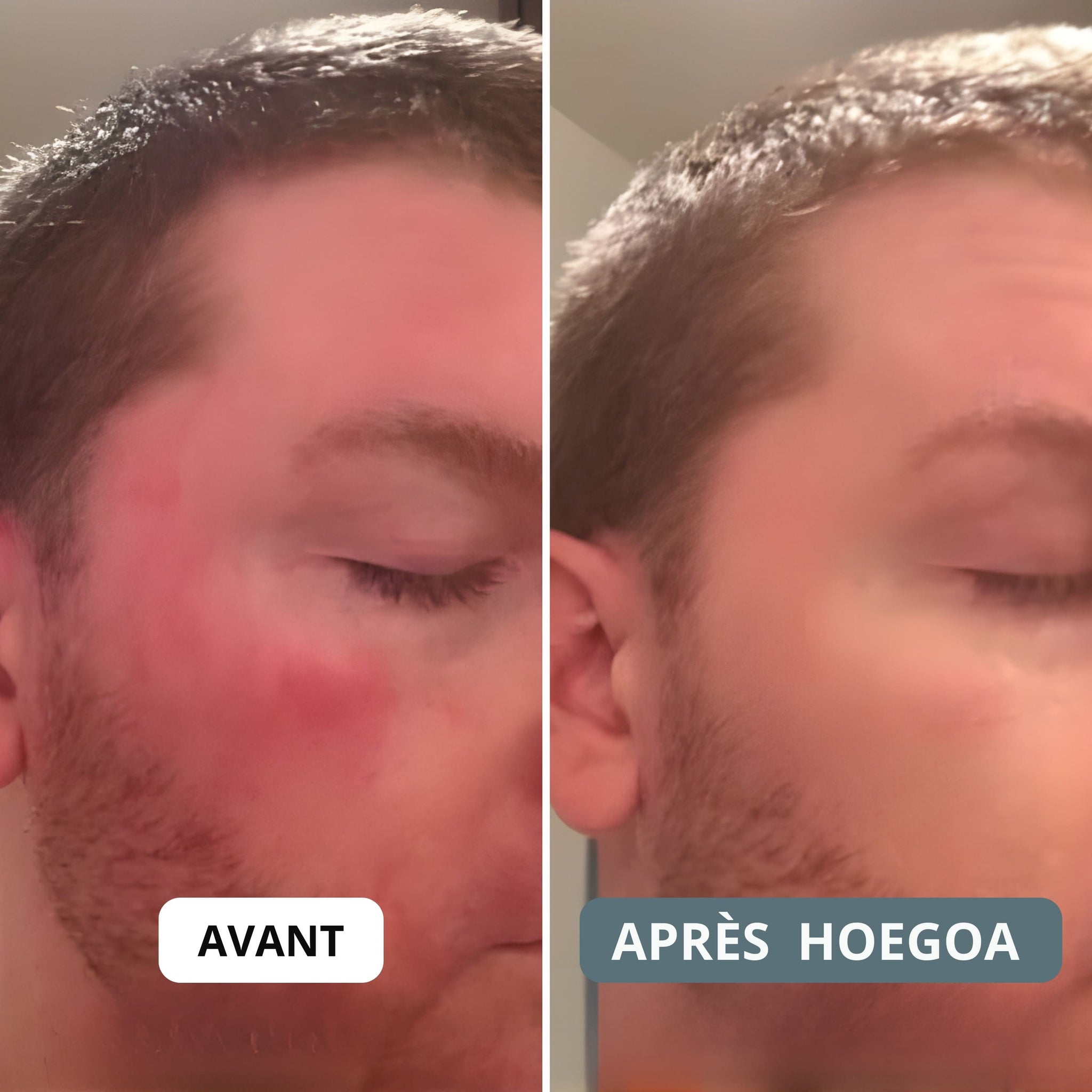 HOEGOA Crème ⎜ Apaise le cuir chevelu et la peau
